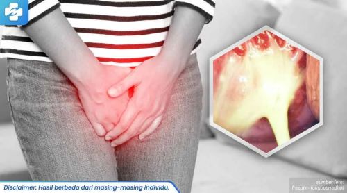 Jual Obat Gonore Keluar Nanah Dari Saluran Kencing Jelambar Baru Jakarta Barat